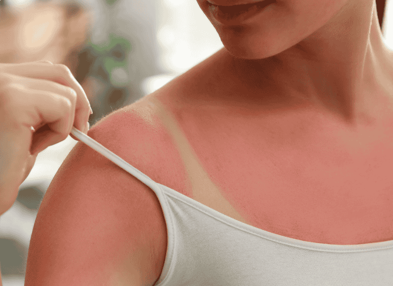 Mis toimub meie nahaga, kui me saame päikesepõletuse?  I Kidsmed