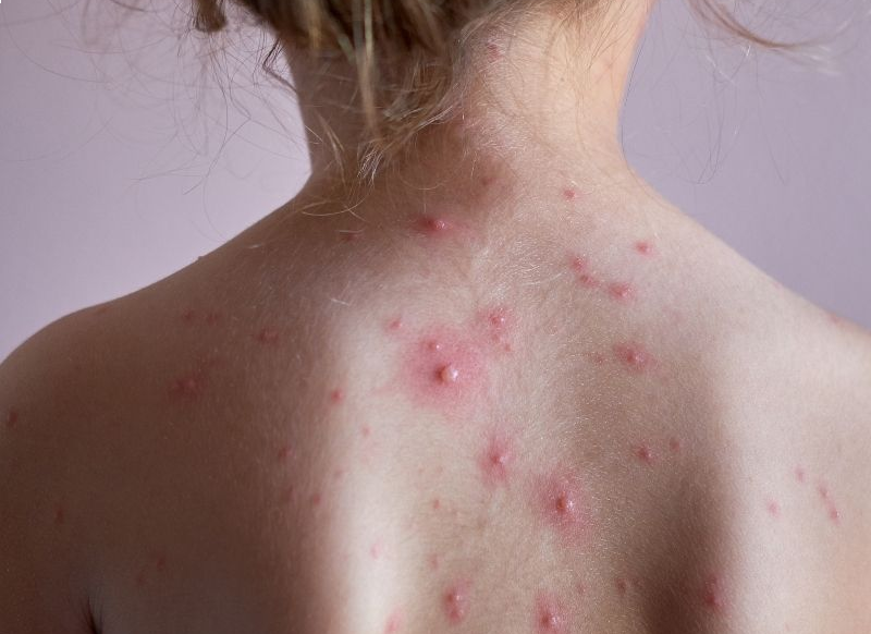  Tuulerõuged lastel: sümptomid, levik ja sügeluse leevendamine| Kidsmed