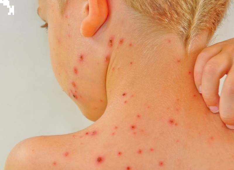 Tuulerõuged lapsel: mida kasutada leevenduseks ja kalamiini kasu | Kidsmed