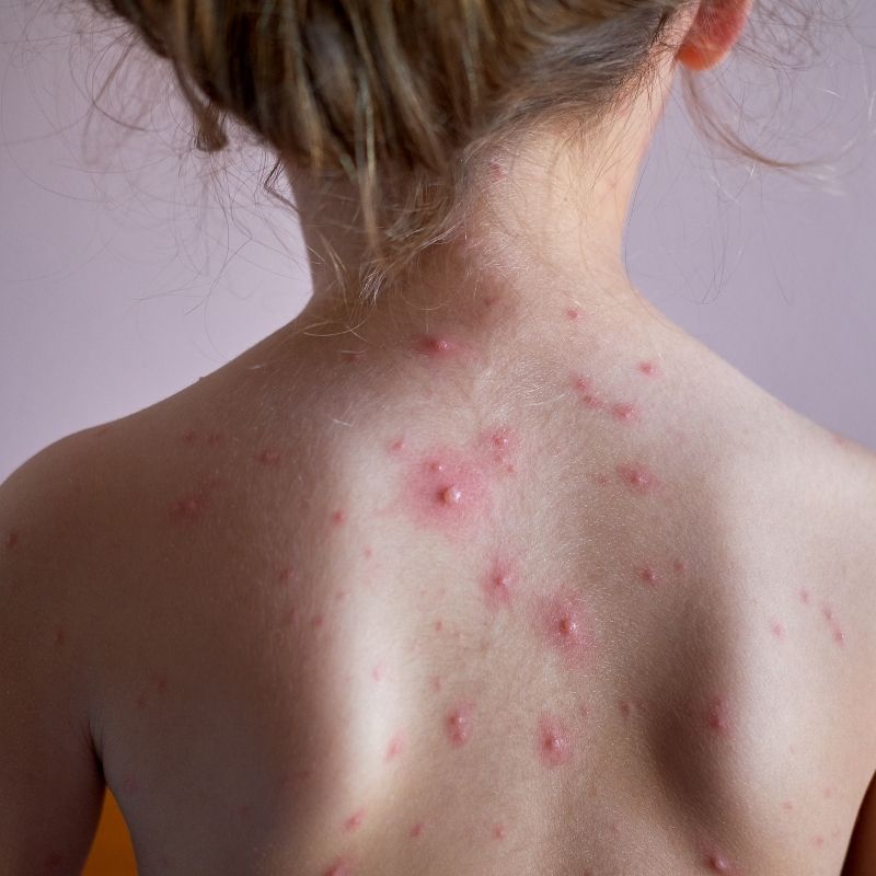  Tuulerõuged lastel: sümptomid, levik ja sügeluse leevendamine| Kidsmed