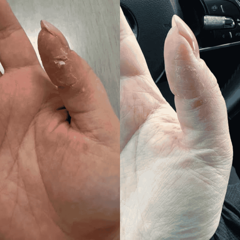 Kliendi käe dermatiit: enne ja pärast (2 päeva vahe)