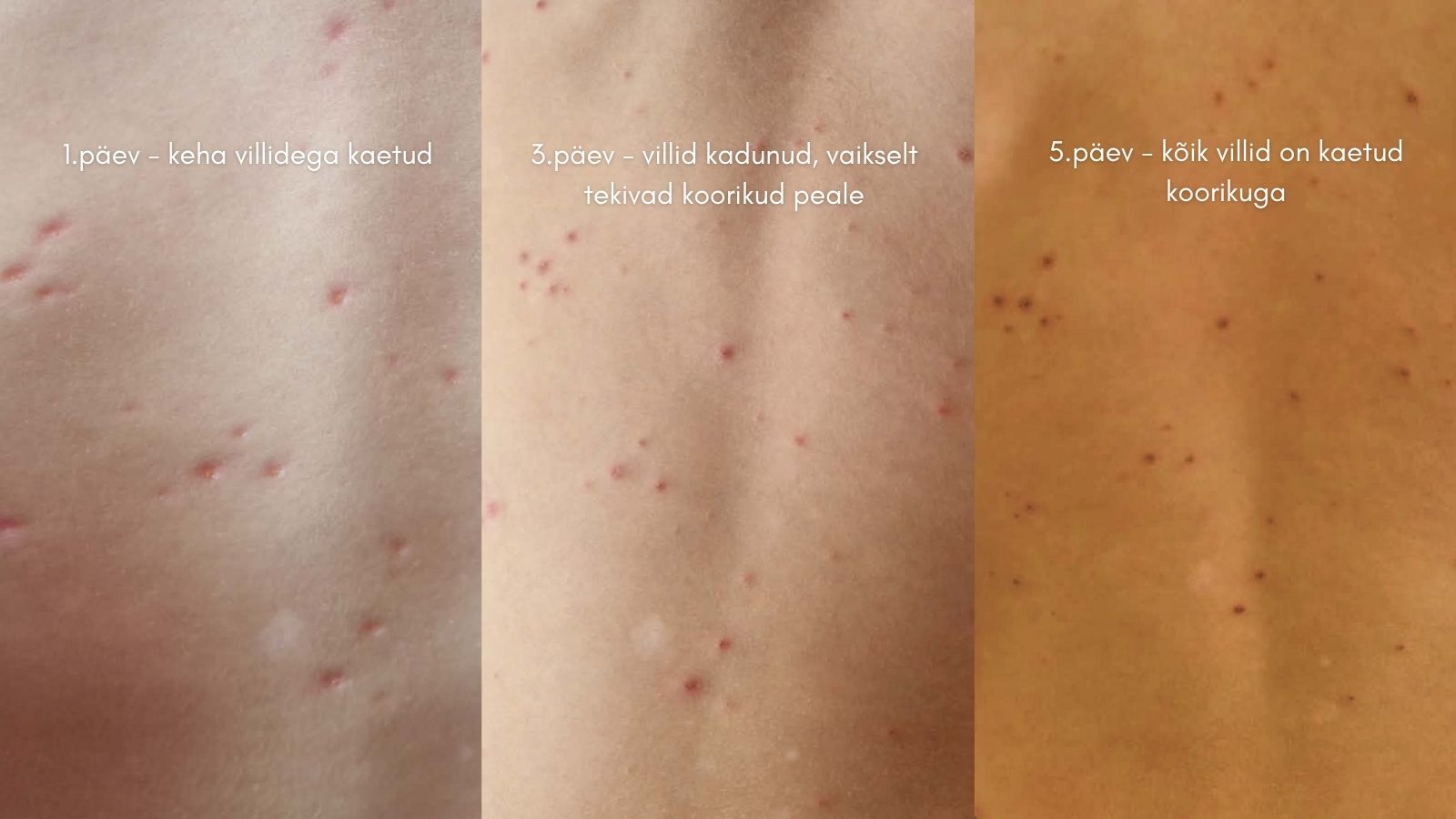 Tuulerõugete villide muutumine: 1. päev, 3. päev ja 5. päev